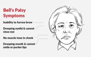 What is Bell’s Palsy? - BLOSSOMS HEALTH CLINIC